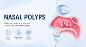 Nowe Polyp Nasal Polyps: Symptoms, Causes, and Treatment Options