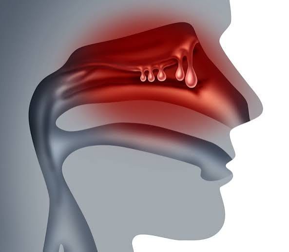 Nasal Polyps Can Contribute to Chronic Symptoms
